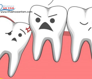  TRƯỜNG HỢP NÀO NÊN NHỔ RĂNG KHÔN VÀ TRƯỜNG HỢP NÀO THÌ KHÔNG NÊN?
