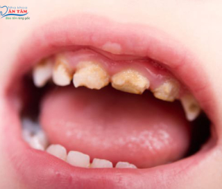 CÁCH ĐIỀU TRỊ XIẾT ĂN RĂNG Ở TRẺ EM AN TOÀN