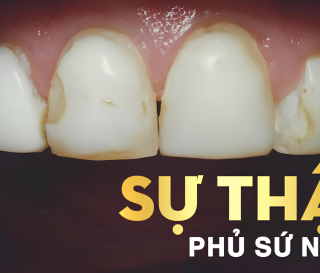 NHA KHOA BẢO TỒN - HẬU QUẢ KHI THỰC HIỆN PHỦ RĂNG SỨ NANO KHÔNG ĐÚNG CÁCH