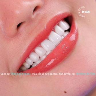 GIẢI PHÁP BẢO TỒN RĂNG THẬT TỐI ĐA TẠI NHA KHOA ÂN TÂM