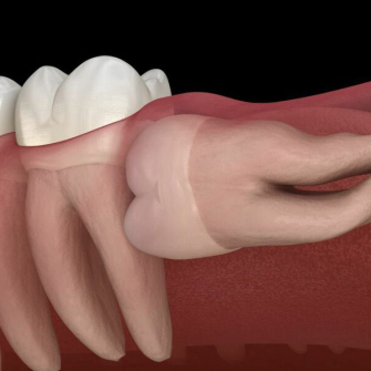 CHUYÊN GIA TƯ VẤN CÁCH KHẮC PHỤC RĂNG SỐ 8 BỊ LỢI TRÙM