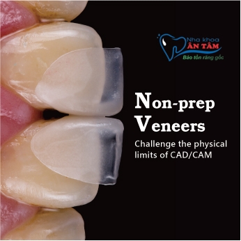 MẶT DÁN SỨ NON-PREP VENEER | NHA KHOA ÂN TÂM | THẾ GIỚI RĂNG SỨ