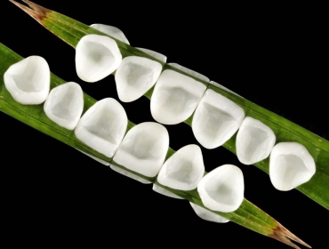 MẶT DÁN SỨ VENEER