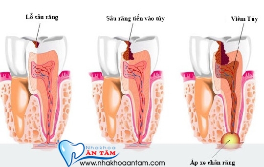 QUY TRÌNH LẤY TỦY RĂNG