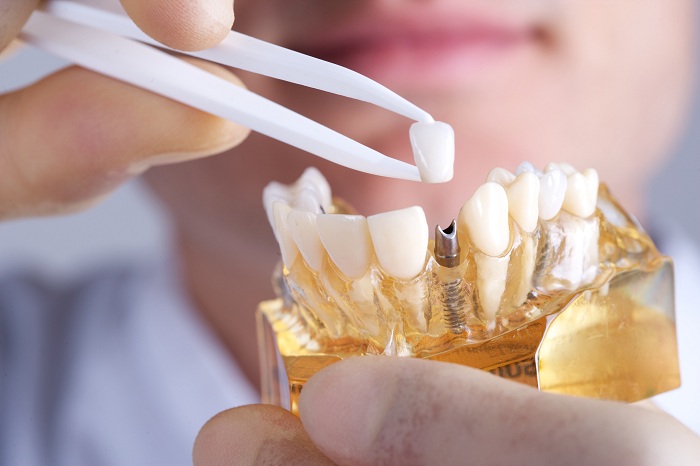 dịch vụ trồng răng implant - Nha khoa Ân Tâm