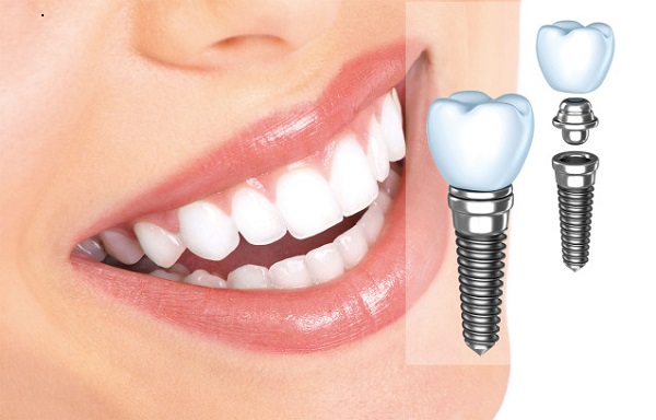   Trồng răng implant là hình thức cấy trực tiếp trụ implant vào trong xương hàm